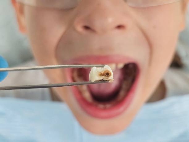Best Emergency Dental Care for Abscessed Tooth in Liberty, IN